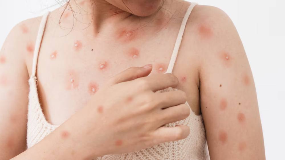 MPOX